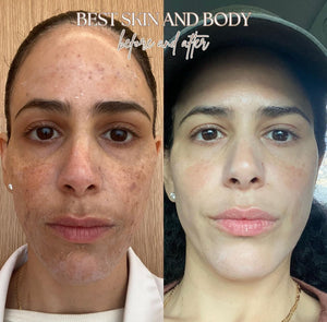 A before and after of a face after using Clear + Brilliant