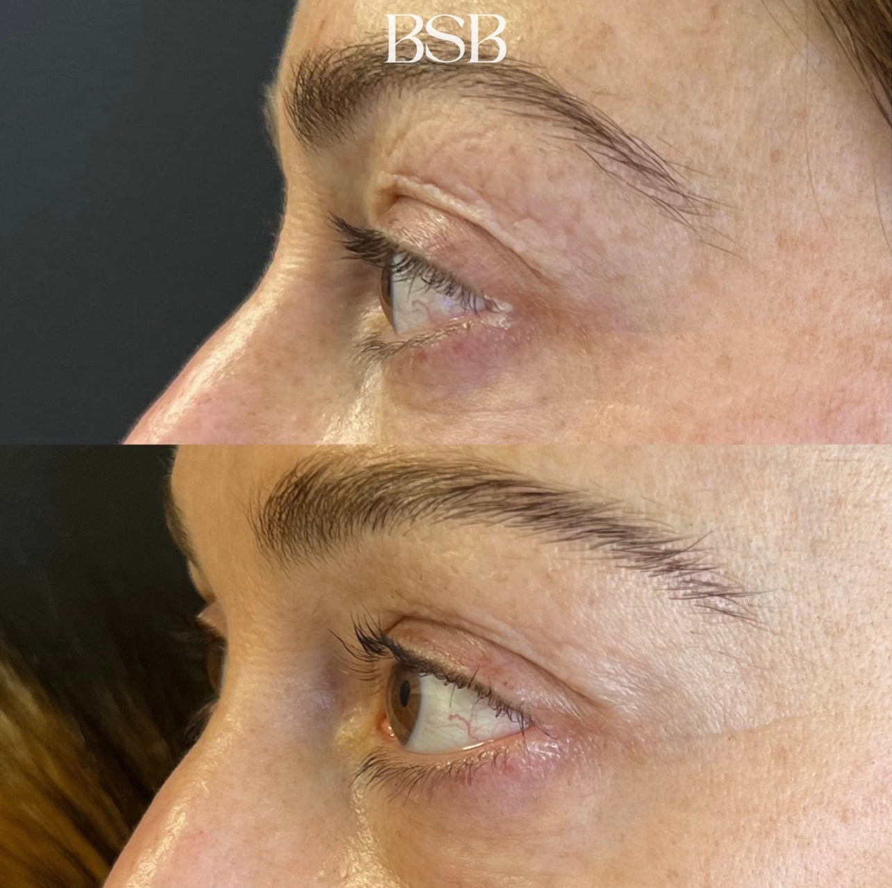 morepheus 8 skin tightening in the eyelid area