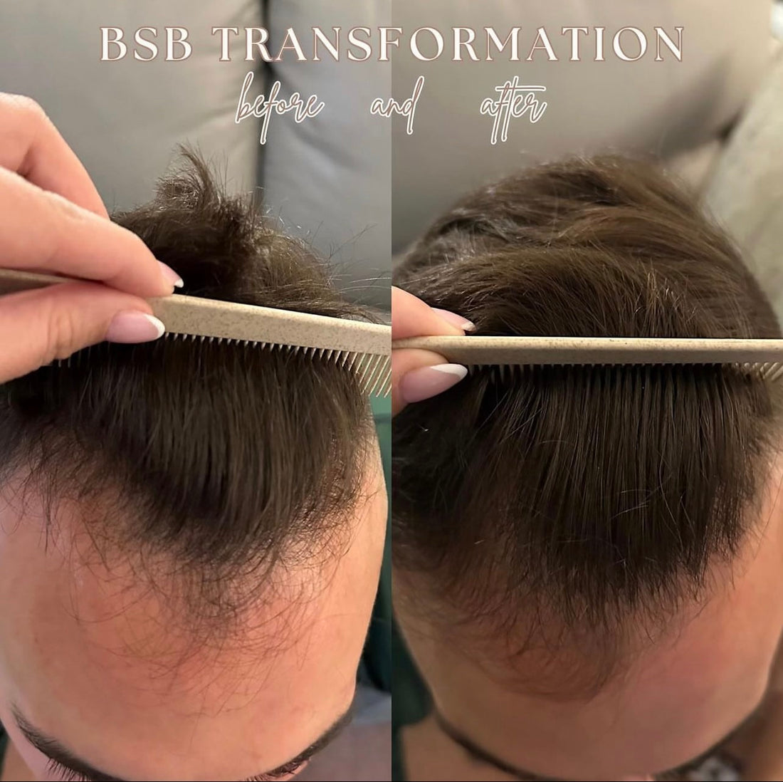 Hair Restoration Blog