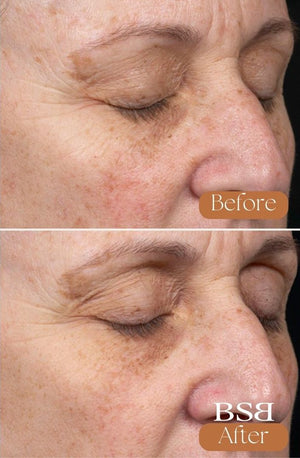A before and after of a face after using Clear + Brilliant