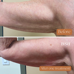 A before and after a bicep showing skin results using the Venus Legacy.