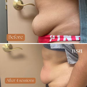 A before and after a stomach showing skin results using the Venus Legacy.