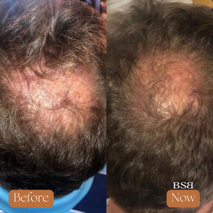 A before and after of the back of a head with a bald spot and hair growth.