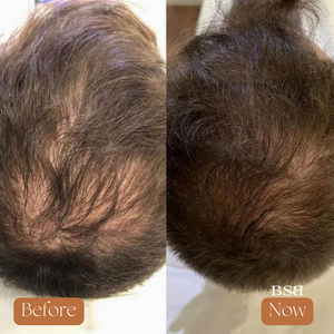 A before and after of the back of a head with a bald spot and hair growth.