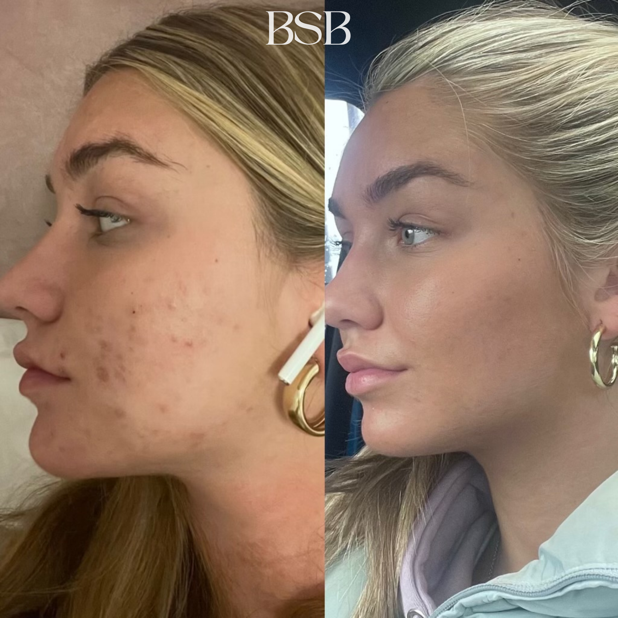 before and after results of our acne boot camp