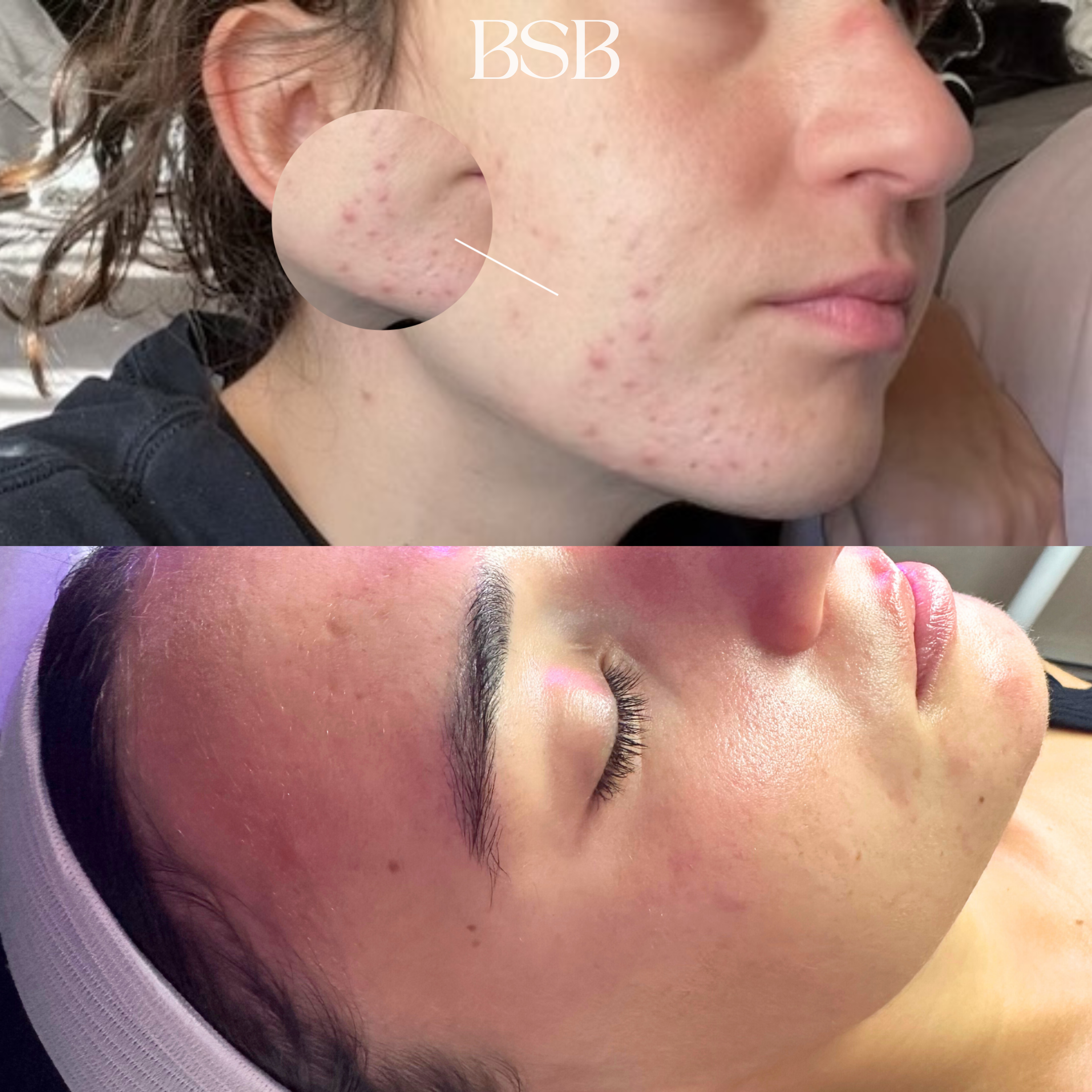 results from our advanced acne bootcamp