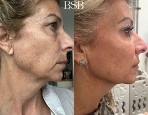 A before and after of a face after using Clear + Brilliant