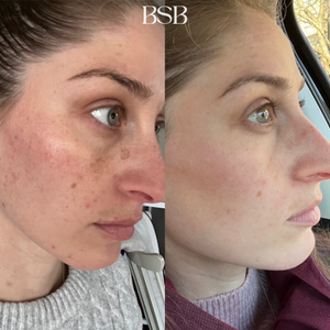 A before and after of a face after using Clear + Brilliant