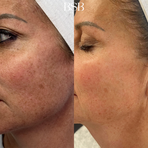 A before and after of a face after using Clear + Brilliant