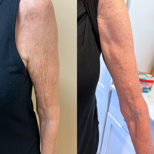 A before and after of an arm tightening and lift with Morpheus8