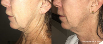 A before and after photo of a neck lift with Morpheus8