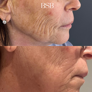 A before and after of a facial tightening and lift with Morpheus8