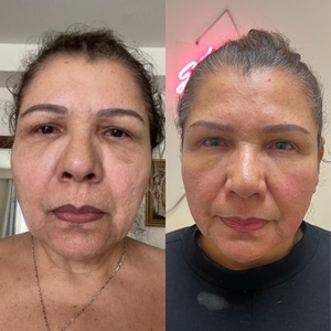 A before and after a face showing skin results using the Venus Legacy.