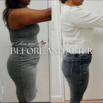 before and after weightloss treatment