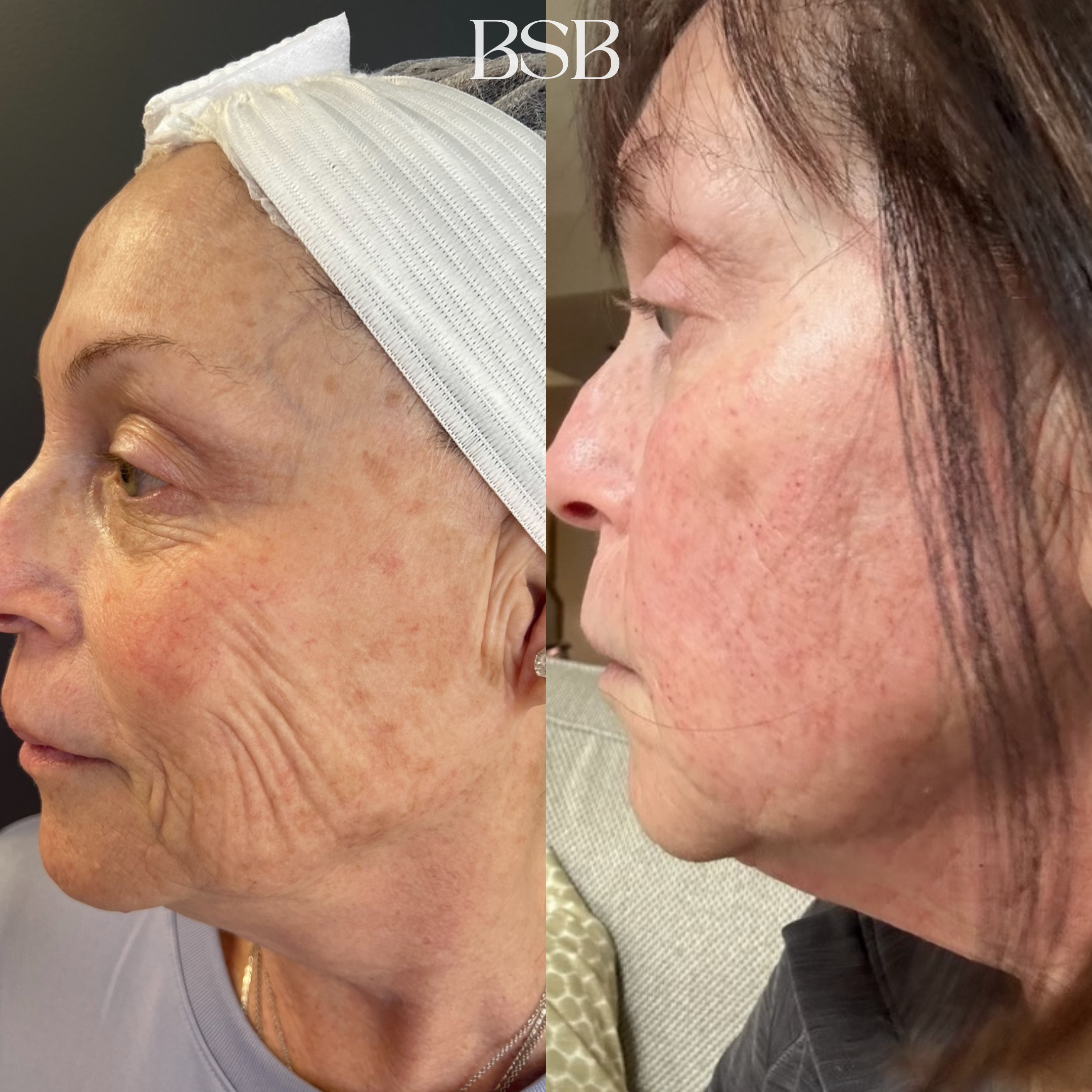 before and after of skin tightening with Morpheus8